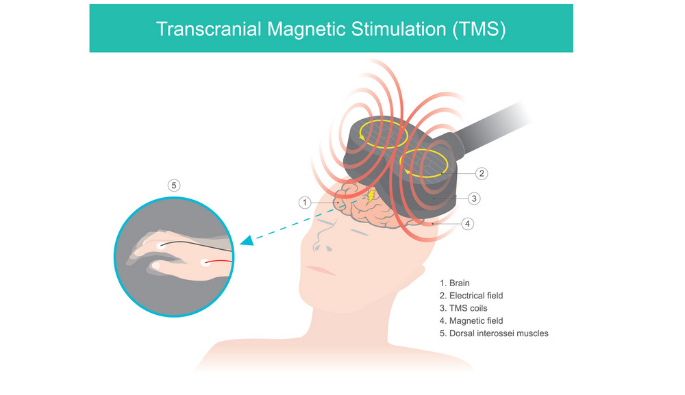what is Transcranial Magnetic Stimulation (TMS) infographic