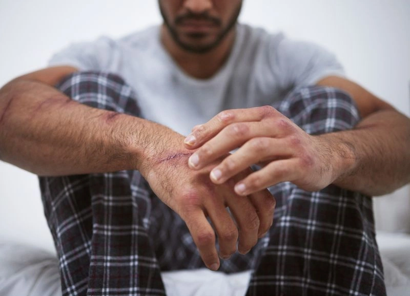 A man sitting on a bed, looking down at his hands with visible scars, symbolizing emotional pain and self-inflicted harm. This image may reflect the difficulties of those with dependent personality disorder, who often struggle with low self-esteem and unhealthy dependence on others.